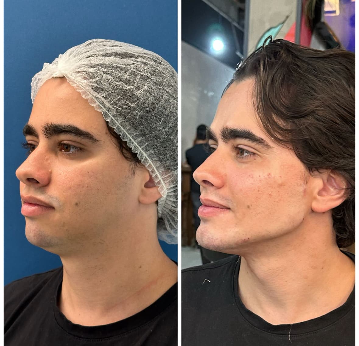 Resultado 1 — Antes e Depois