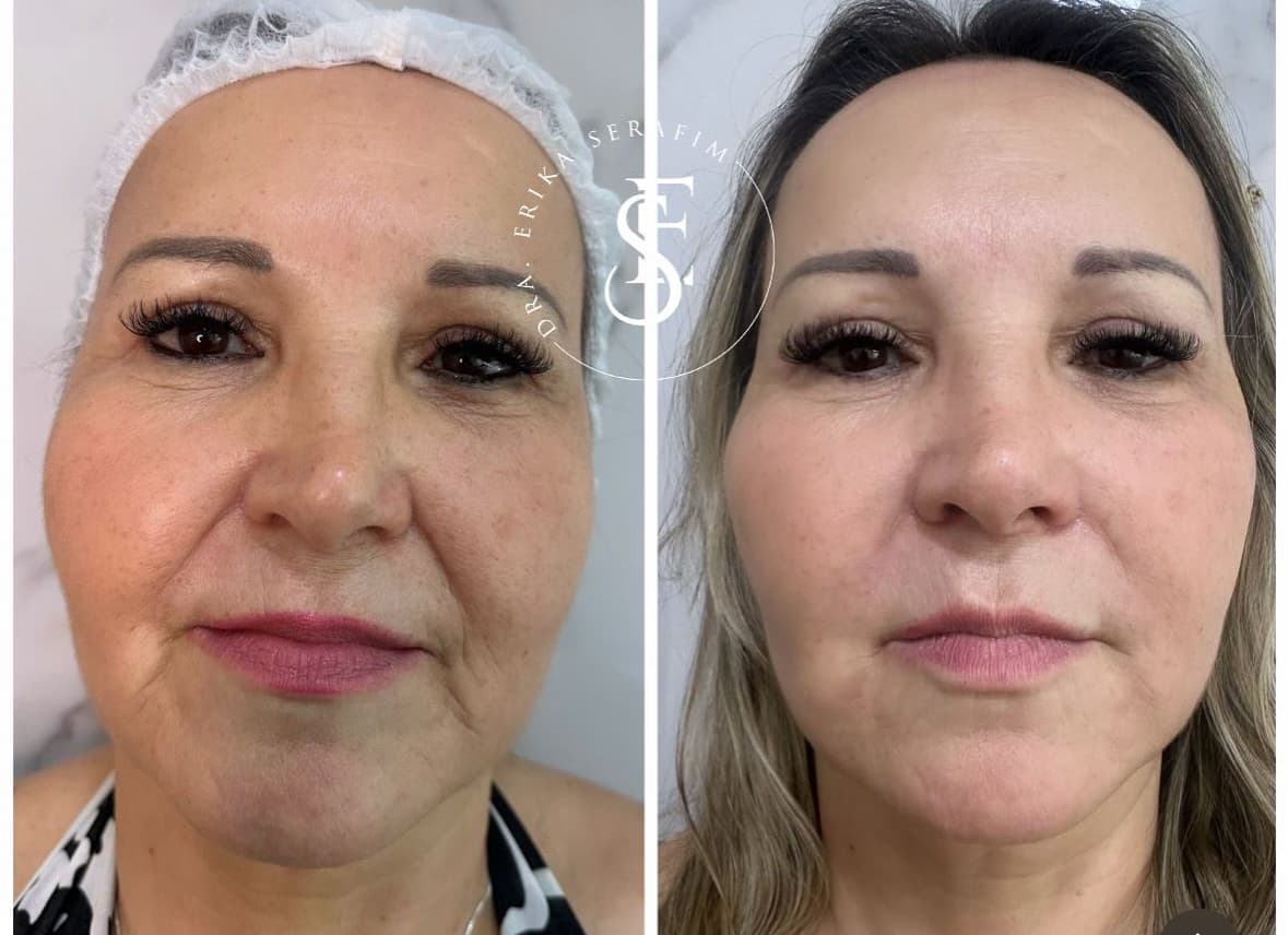 Resultado 10 — Antes e Depois