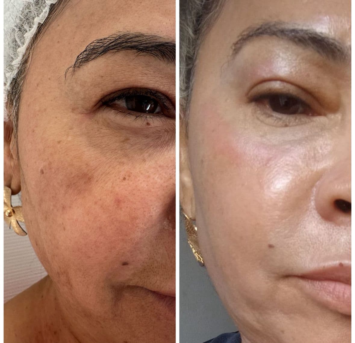 Resultado 11 — Antes e Depois