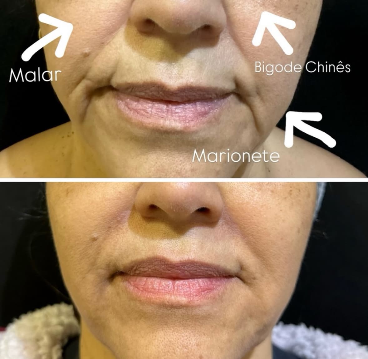 Resultado 11 — Antes e Depois