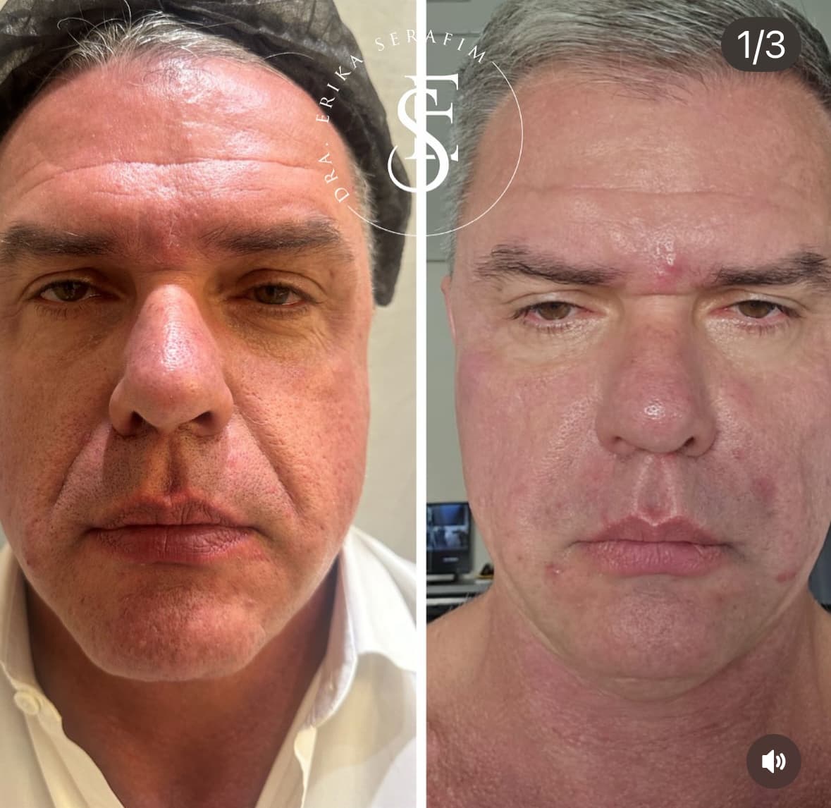 Resultado 2 — Antes e Depois