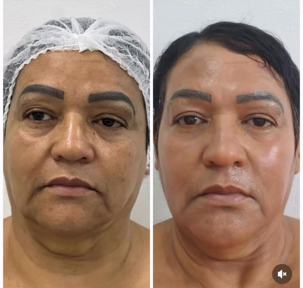 Resultado 3 — Antes e Depois