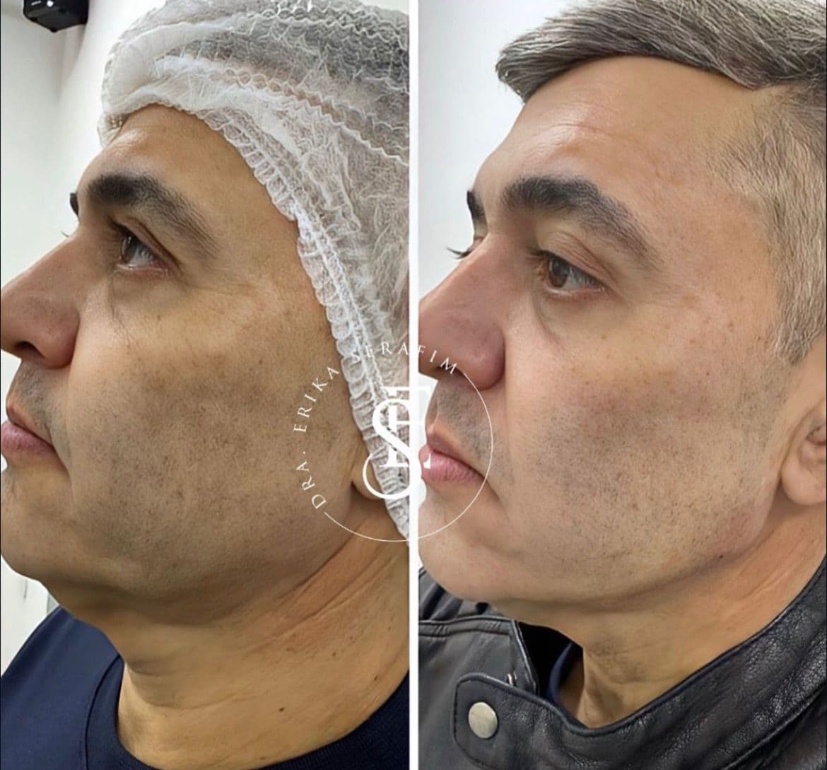 Resultado 3 — Antes e Depois