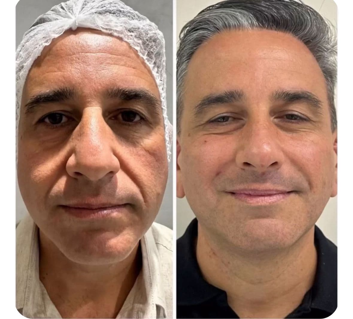 Resultado 4 — Antes e Depois