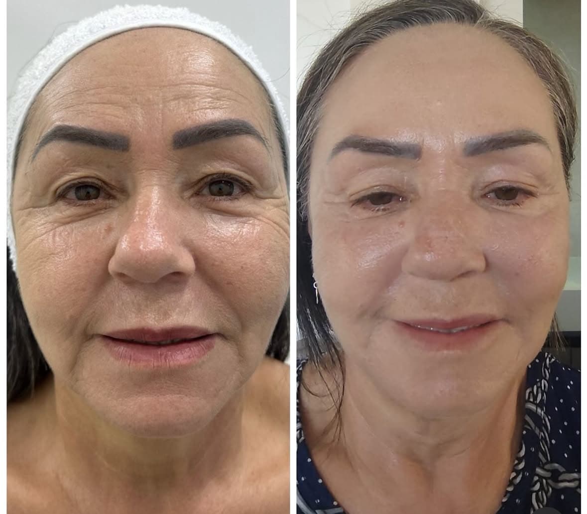 Resultado 8 — Antes e Depois