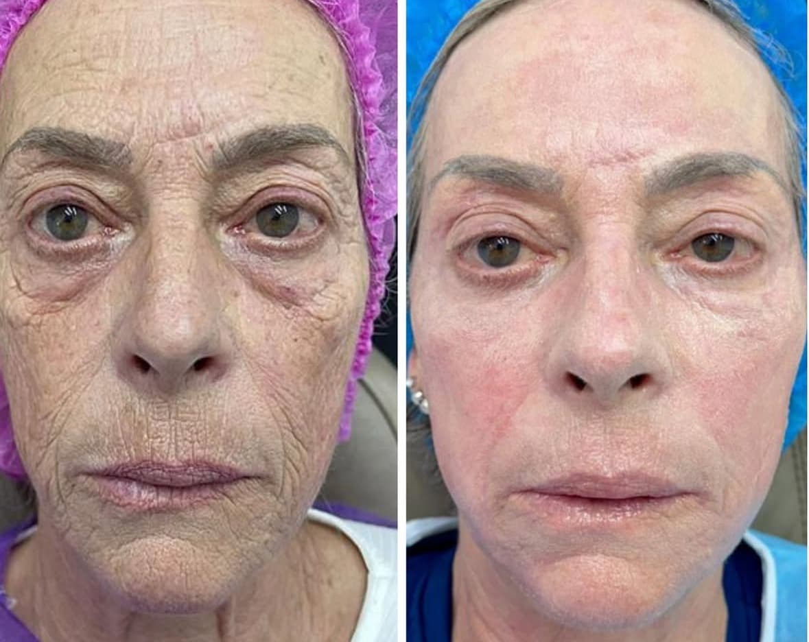 Resultado 9 — Antes e Depois